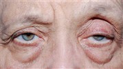 تفاوت بلفاروپلاستی با پتوز چیست؟