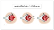 درمان شقاق یا فیشر مقعد با جراحی اسفنکتروتومی