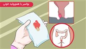 درمان بواسیر خونی  با لیزر، روش‌های پزشکی و طب سنتی 