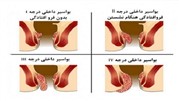 بواسیر داخلی و خارجی چیست؟