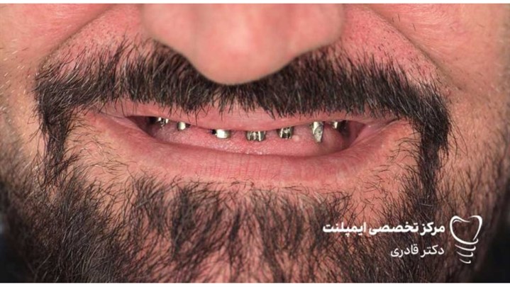 قیمت جدید ایمپلنت دندان در سال ۱۴۰۴ اعلام شد