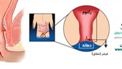 بهترین روش درمان شقاق مقعدی در کلینیک پایتخت 