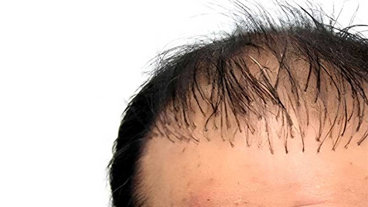 دلایل شکست و ناموفق بودن نتیجه کاشت مو دلایل شکست و ناموفق بودن نتیجه کاشت مو