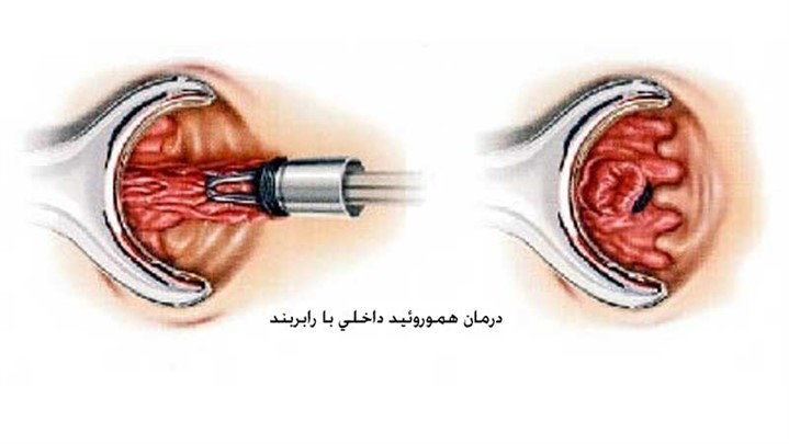 رابربند چیست و چگونه باعث درمان بواسیر یا هموروئید می شود؟ رابربند چیست و چگونه باعث درمان بواسیر یا هموروئید می شود؟