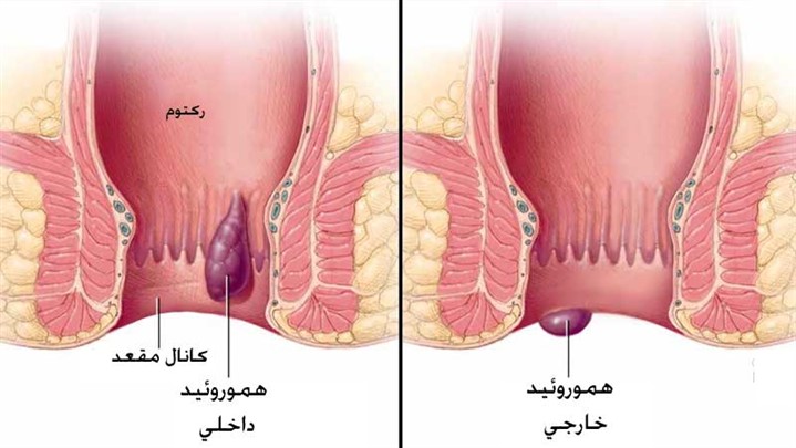 بواسیر داخلی و خارجی چیست؟ علائم و روش های درمان آن بواسیر داخلی و خارجی چیست؟ علائم و روش های درمان آن