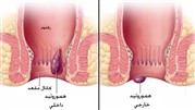 بواسیر داخلی و خارجی چیست؟