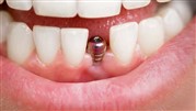ایمپلنت دندان جلو امکان پذیر است؟
