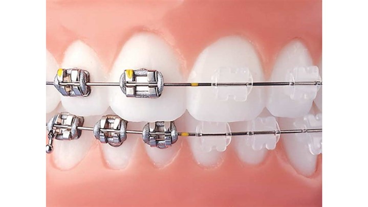 تکنیک های مختلف ارتودنسی ثابت