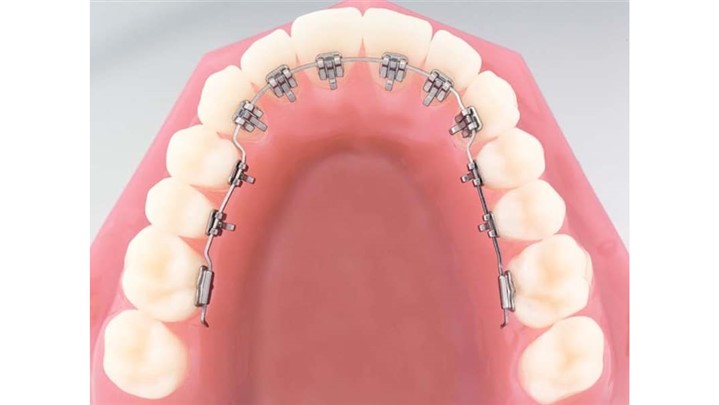 تکنیک های مختلف ارتودنسی ثابت