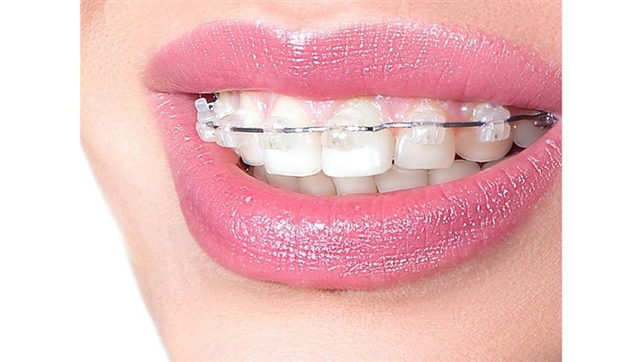 تکنیک های مختلف ارتودنسی ثابت