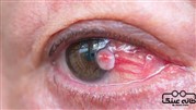 آشنایی با pterygium و معرفی بهترین روش برای از بین بردن ناخنک چشم