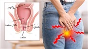  درمان شقاق مقعد با لیزر و بدون جراحی