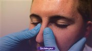 دلایل بیرون زدگی غضروف بینی بعد از عمل رینوپلاستی
