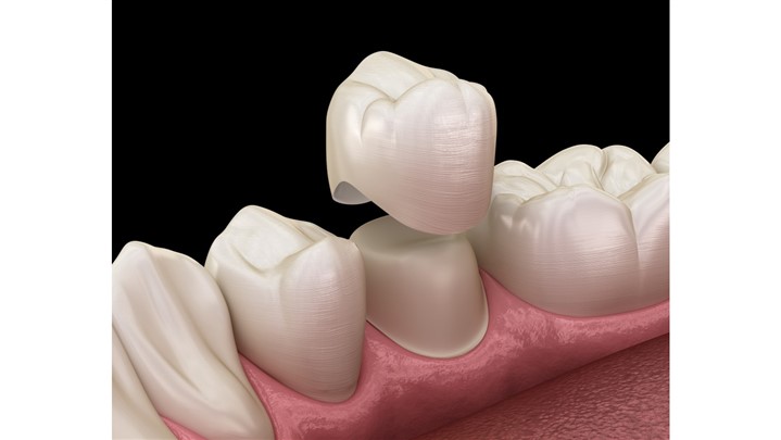 با ارزان ترین روش جایگزینی دندان از دست رفته آشنا شوید