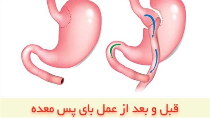 عمل اسلیو معده بهتر است یا بای پس معده؟
