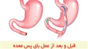 عمل اسلیو معده بهتر است یا بای پس معده؟