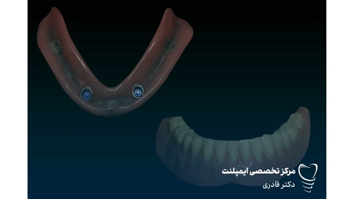 اوردنچر ثابت یا متحرک؟ مقایسه تخصصی از نظر قیمت، دوام و راحتی بیمار اوردنچر ثابت یا متحرک؟ مقایسه تخصصی از نظر قیمت، دوام و راحتی بیمار