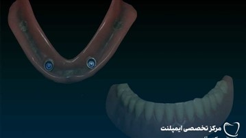 اوردنچر ثابت یا متحرک؟ مقایسه تخصصی از نظر قیمت، دوام و راحتی بیمار اوردنچر ثابت یا متحرک؟ مقایسه تخصصی از نظر قیمت، دوام و راحتی بیمار