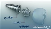 قیمت جدید ایمپلنت در سال جدید 