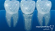 کاربرد روش جدید ایمپلنت دیجیتالی در تهران  
