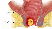بررسی دلایل بروز سرطان مقعد و راه‌های درمان آن 