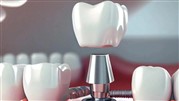 ایمپلنت دندان چیست؟ گزارش ویژه از جدیدترین روش جایگزینی دندان