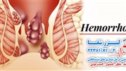 لیزر بواسیر یا همان هموروئید
