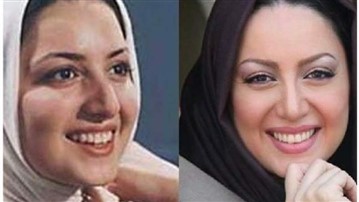 آیا شیلاخداد عمل جراحی بینی انجام داده است؟ آیا شیلاخداد عمل جراحی بینی انجام داده است؟