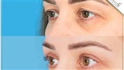 درباره جراحی زیبایی پلک (بلفاروپلاستی)
