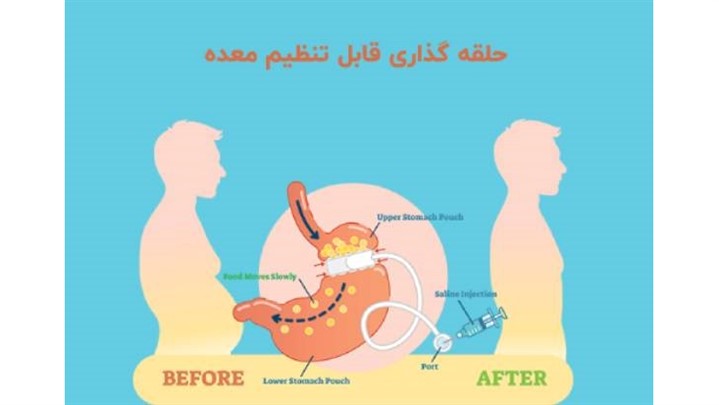 بهترین عمل جراحی لاغری چیست؟ بهترین عمل جراحی لاغری چیست؟