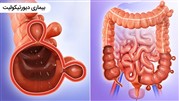 کولون سیگموئید چیست و چه رابطه‌ای با بیماری دیورتیکولیت دارد؟