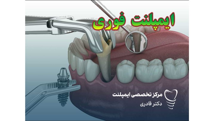 آیا ایمپلنت فوری واقعاً قابل اعتماد است؟ بررسی مزایا و معایب آیا ایمپلنت فوری واقعاً قابل اعتماد است؟ بررسی مزایا و معایب