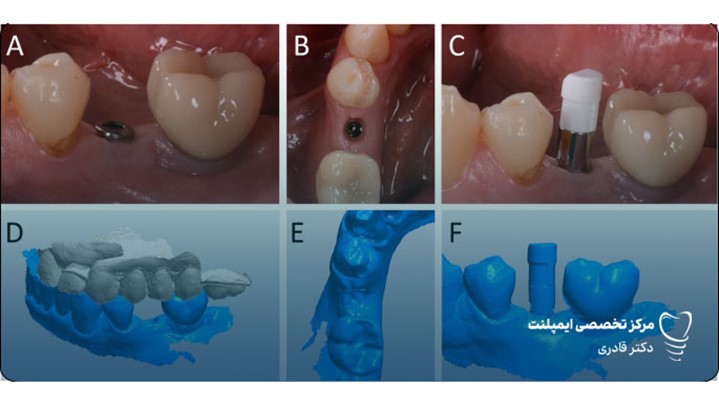 انجام جدید ترین روش کاشت ایمپلنت دندان 