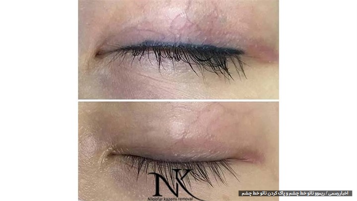 ریموو تاتو خط چشم در مرکز ریموو تاتو نیلوفر کاظمی در یک جلسه ریموو تاتو خط چشم در مرکز ریموو تاتو نیلوفر کاظمی در یک جلسه