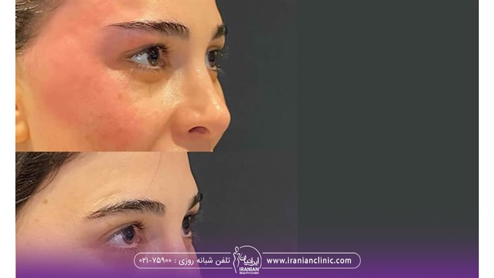 اندولیفت صورت چیست؟