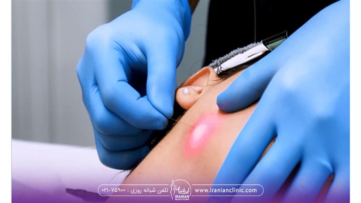 اندولیفت صورت چیست؟