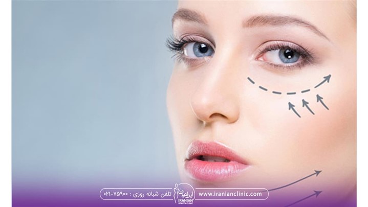 اندولیفت صورت چیست؟