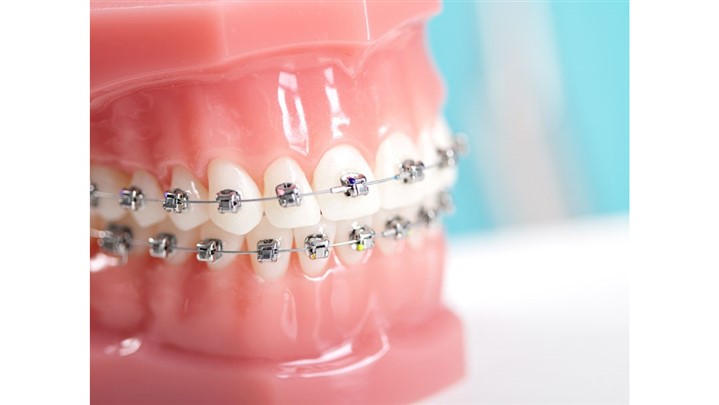 همه چیز درباره ارتودنسی ثابت