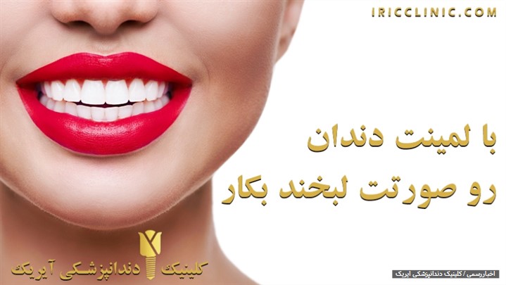 قیمت لمینت دندان 1400 (تخفیف ویژه)