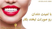 قیمت لمینت دندان 1400 (تخفیف ویژه)