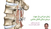 زمان جراحی باز جهت درمان تنگی کانال نخاعی
