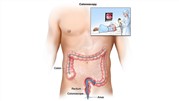 آزمایش کولونوسکوپی چگونه انجام می‌شود؟