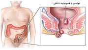 بواسیر یا هموروئید داخلی، علائم، دلایل و راه‌های درمان