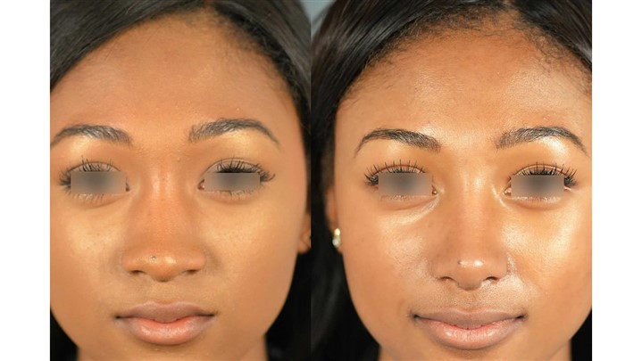 دستگاه کوچک‌کننده بینی؛ واقعیت‌ها، مزایا و محدودیت‌ها