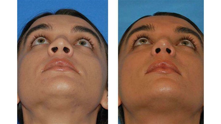 دستگاه کوچک‌کننده بینی؛ واقعیت‌ها، مزایا و محدودیت‌ها