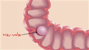 پولیپ روده بزرگ چیست و چه علائمی دارد؟ 