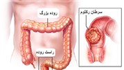 سرطان رکتوم یا راست روده