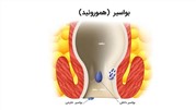 بررسی بواسیر یا هموروئید خارجی و داخلی در زنان و مردان