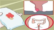 علائم بواسیر خونی، روش‌های درمان پزشکی و خانگی در ایران کلینیک