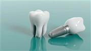 ایمپلنت دندان؛ از مشاوره تا مراقبت‌های پس از عمل